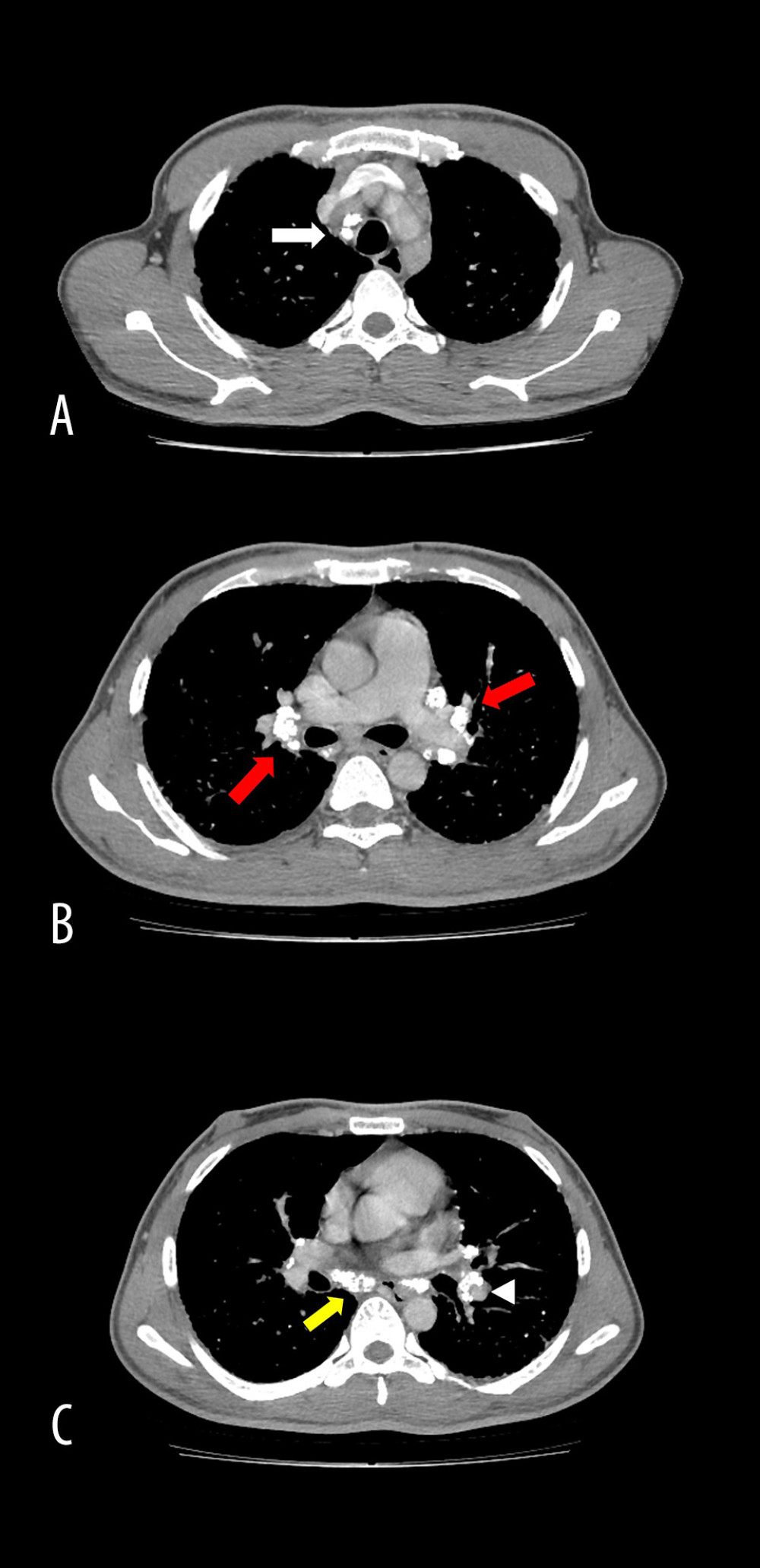 Axial CT (soft tissue window with contrast) images show enlarged lymph nodes with characteristic eggshell calcifications in the right paratracheal area (A; white arrow); hilar area (B; red arrows), subcarinal area (C; yellow arrow), and left peribronchial region (C; white arrowhead).