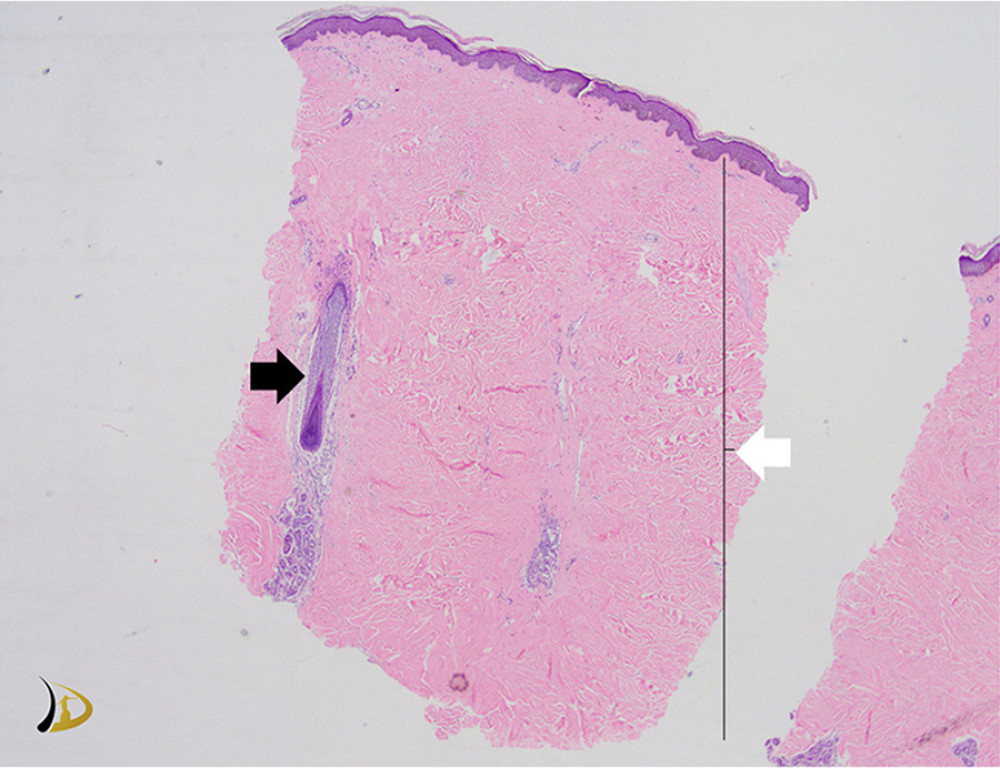 Skin biopsy of the upper back showing thickening of collagen bundles involving almost the entire dermis (white arrow). Collagen in the papillary dermis appears homogenized to a certain extent, including in the tissue surrounding the hair follicle (black arrow).