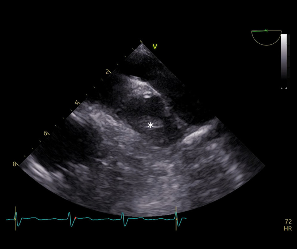 Transesophageal echocardiography (TEE) image recorded before the procedure. TEE image showing the thrombus (white star) and abundant sludge inside the left atrial appendage.