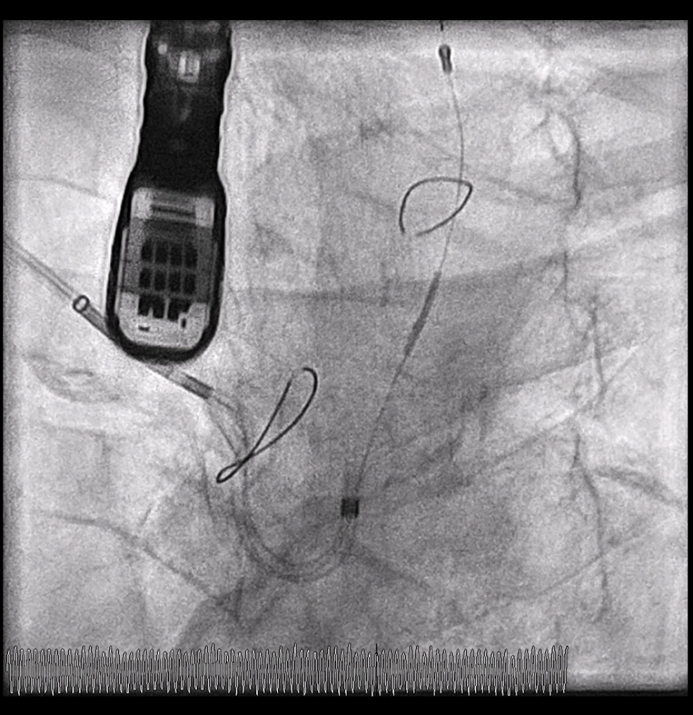 Fluoroscopic view of the SENTINEL system after delivery. Fluoroscopy image showing the cerebral protection system in place, with the distal filter opened inside the left common carotid artery and the proximal filter inside the brachiocephalic artery.