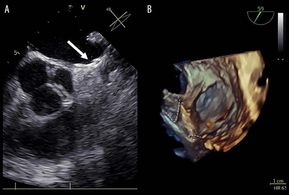 Echocardiographic images of the LAmbre device after implantation. (A) Transesophageal echocardiography (TEE) image of the sealed left atrial appendage (LAA) after occluder (white arrow) implantation; (B) Three-dimensional (3D) echocardiographic image of the LAA occluder (bordered by dashed lines) after implantation.