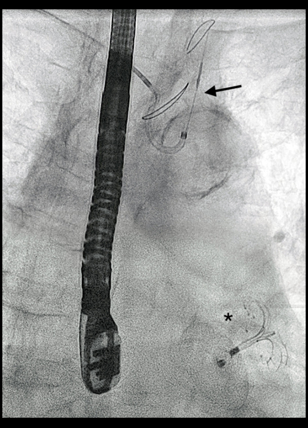 Fluoroscopic view of the LAmbre device and the SENTINEL system after delivery. Fluoroscopy image showing the left atrial appendage occluder after delivery (black star) and the cerebral protection device (black arrow) in place.