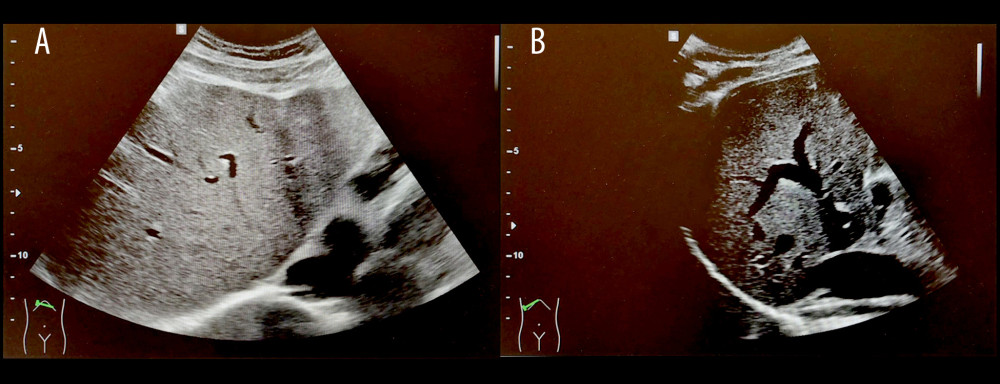 (A, B) Image of ultrasonography of the upper abdomen. The analysis revealed a normal size, contour, and parenchymal echogenicity of the liver. No space-occupying lesion was present, and no intrahepatic bile duct or common bile duct dilatation was noted.