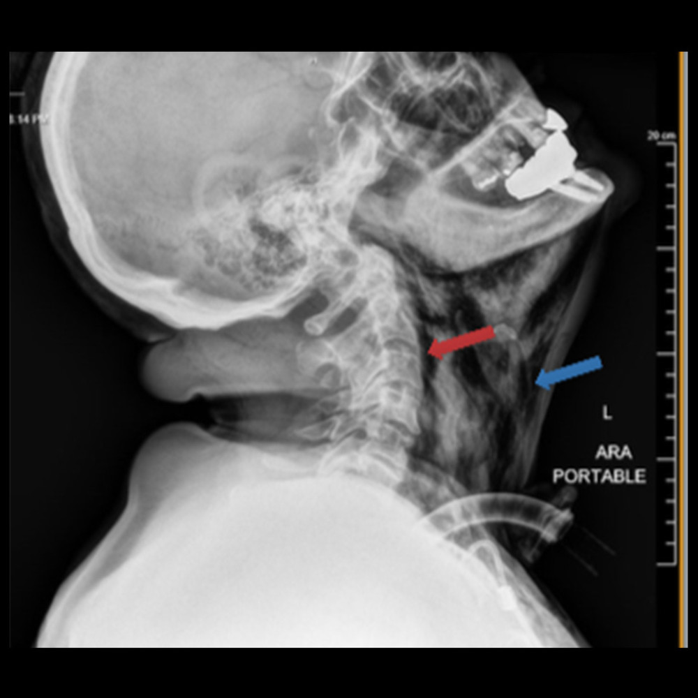 Extensive surgical emphysema in the soft tissues of the neck (blue arrow) and retropharyngeal space (red arrow).