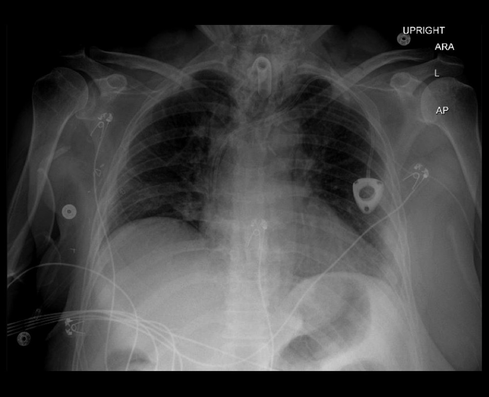 Chest X-ray with no evidence of pneumothorax.