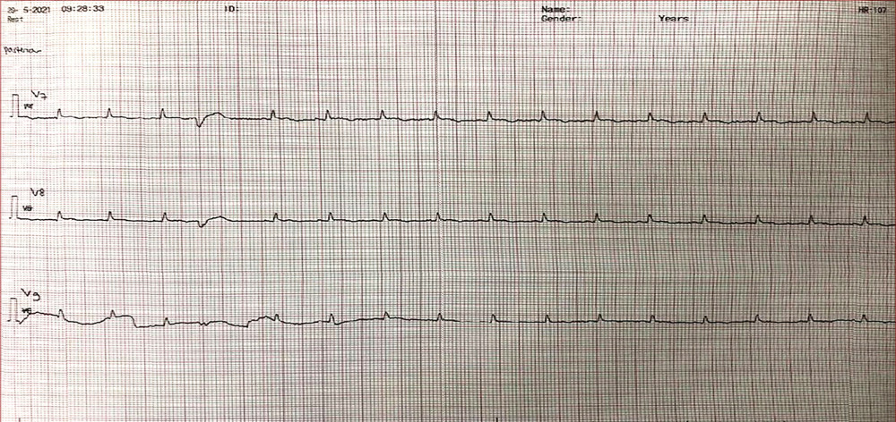 ECG on posterior segment showed ST elevation in V7–V9 and occasional premature ventricle contraction.