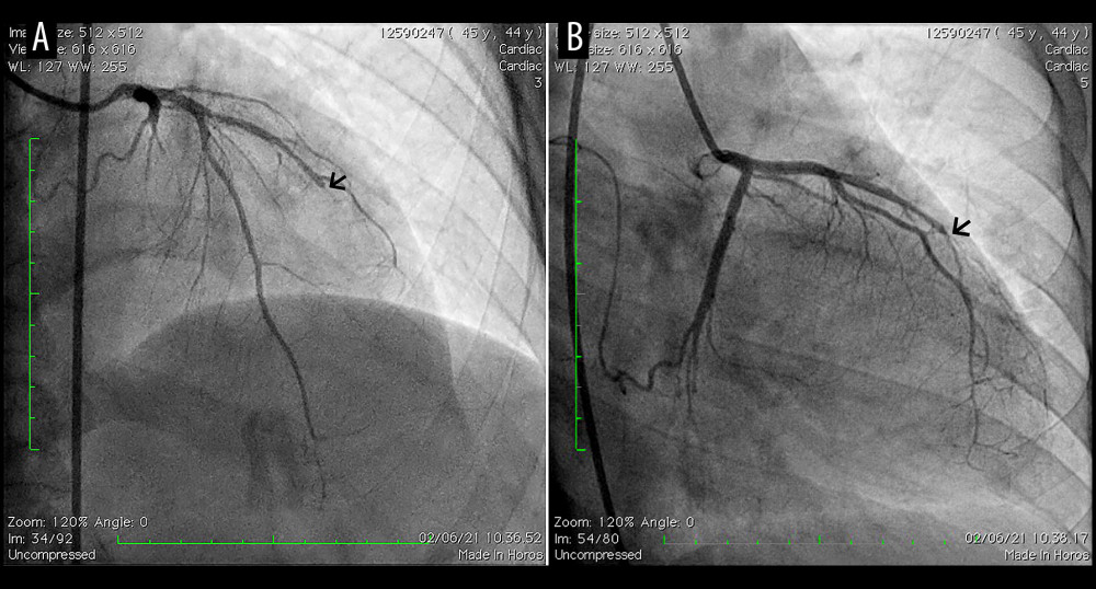 (A) Pre-catheterized coronary angiography RAO caudal view showed total occlusion of the first diagonal branch of the left anterior descending artery (LAD). (B) RAO cranial view also revealed total occlusion of the first diagonal branch of the LAD (shown by arrow).