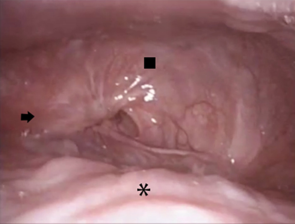 Endoscopic fibreoptic finding of the oropharyngeal stenosis: base of tongue (the asterisk), posterior oropharyngeal wall (square) and oropharyngeal stenosis (arrow).