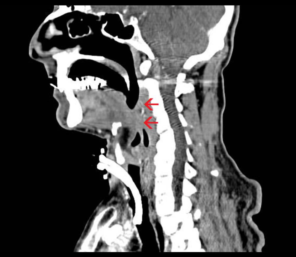 CT scan (sagittal view) showing the oropharyngeal stenosis (red arrows).