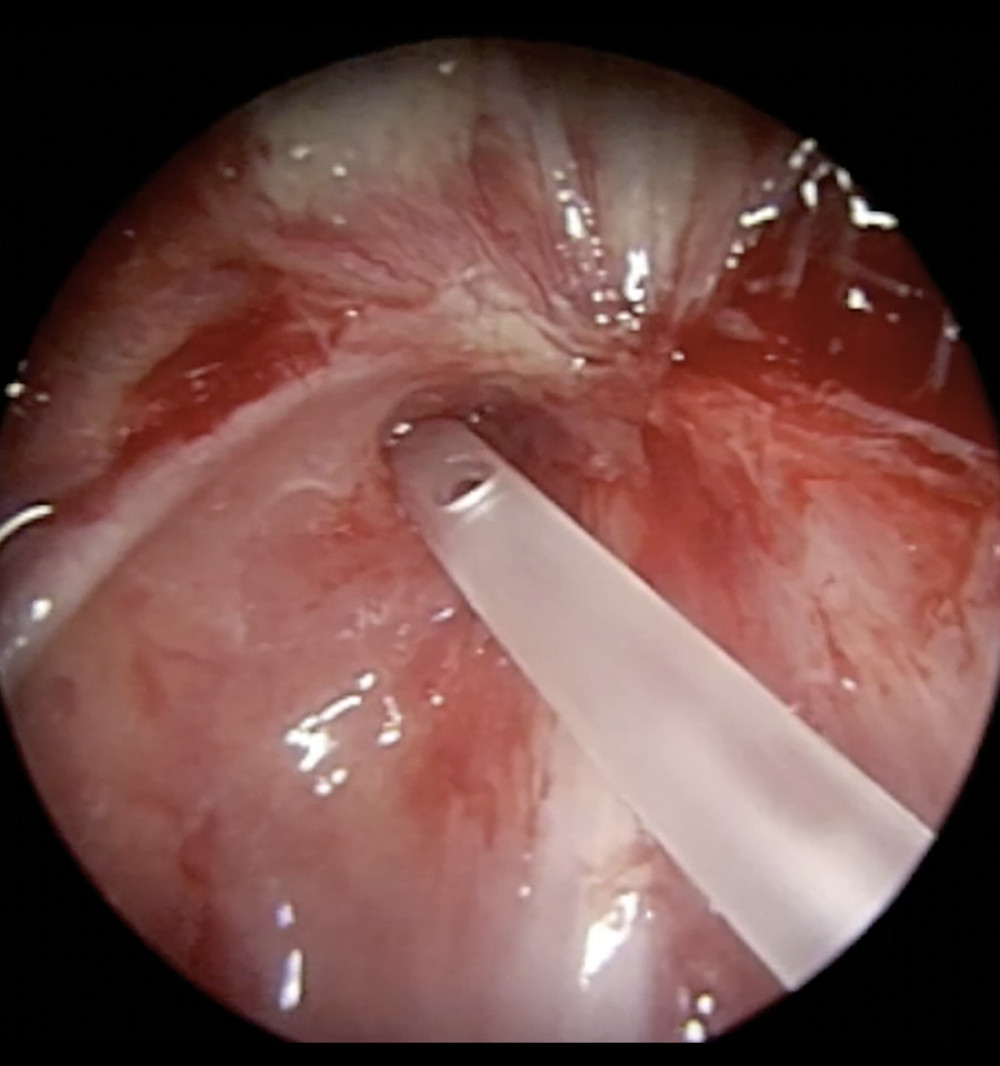 Endoscopic intraoperative view of the oropharyngeal stenosis with a Nélaton catheter trying to pass the stenosis.