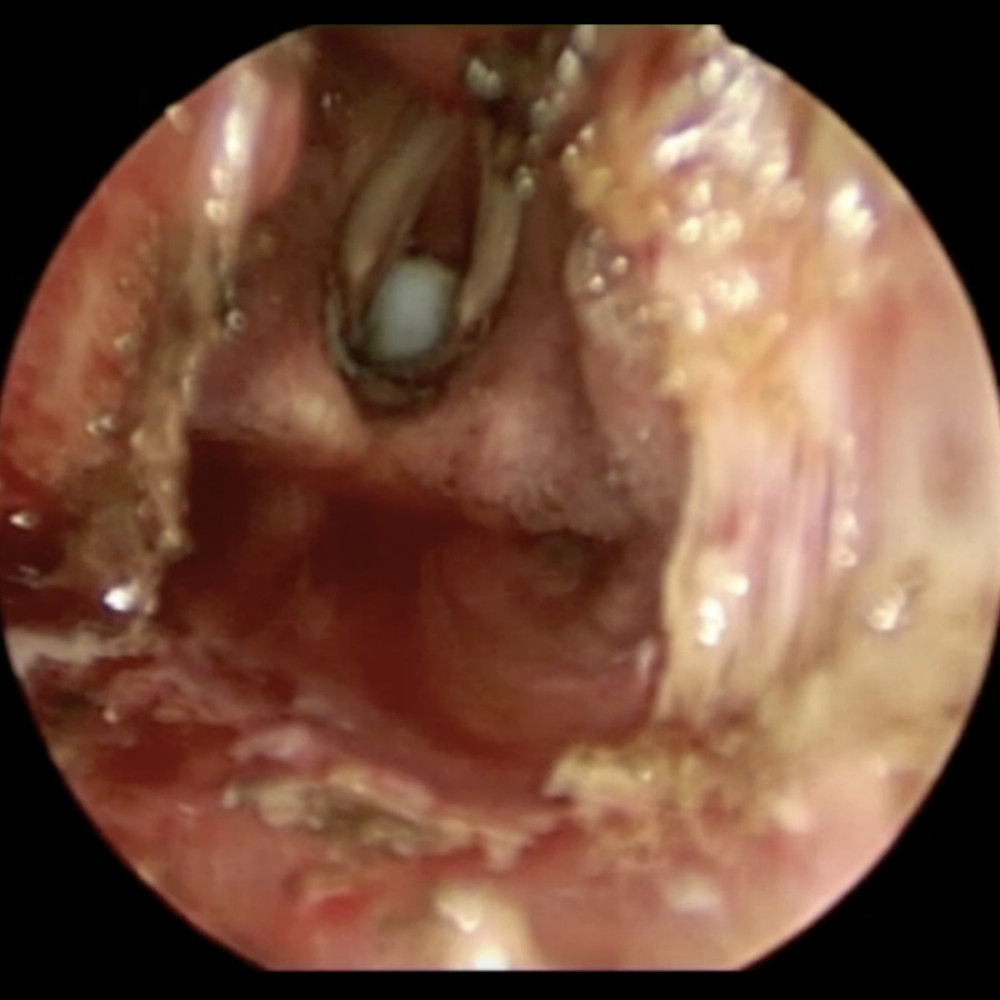 Endoscopic intraoperative laryngeal view after the scar resection.