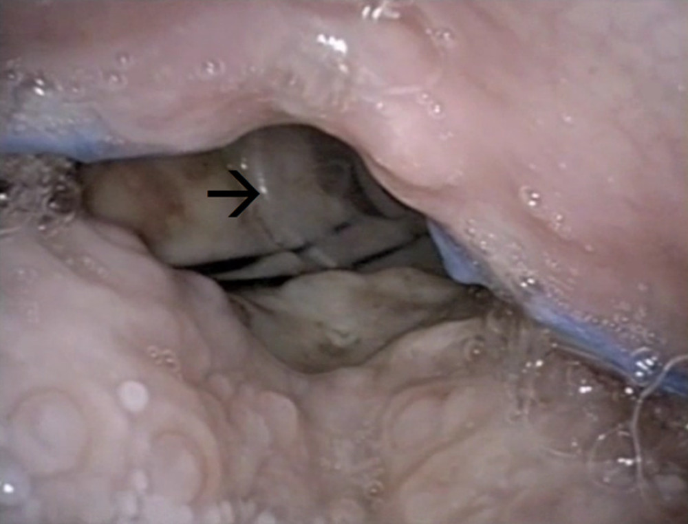 Postoperative endoscopic control with salivary stent (black arrow) in the hypopharynx.