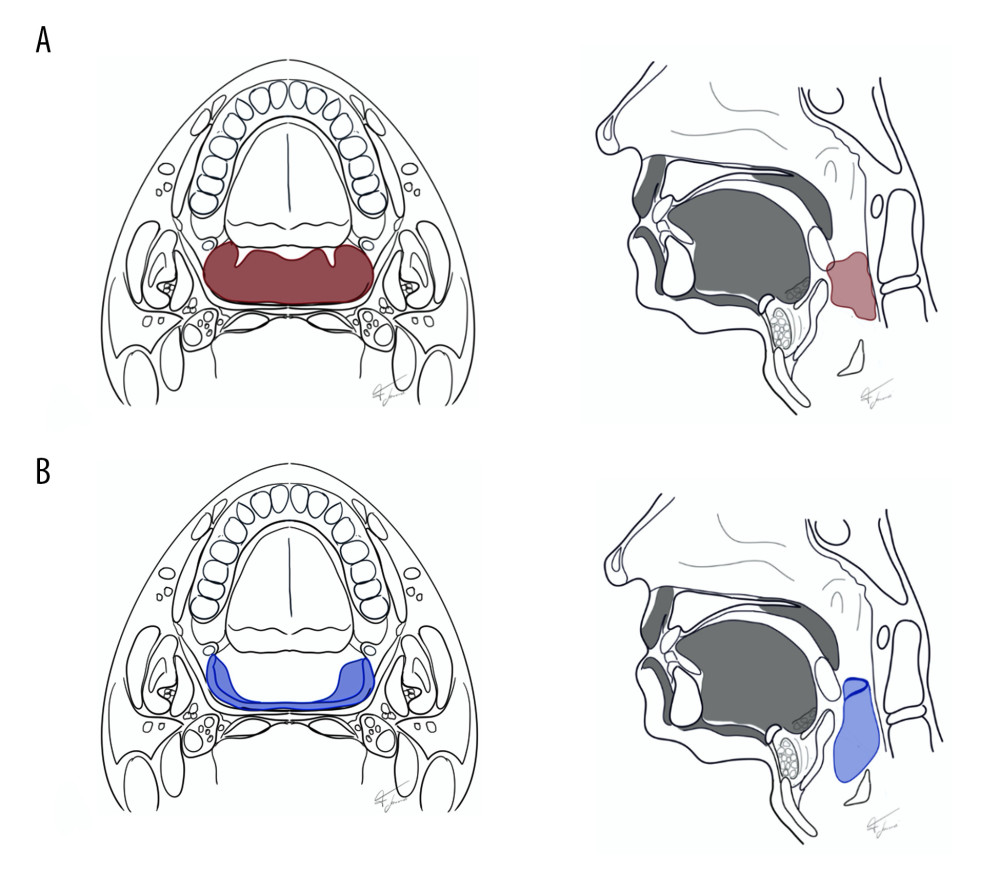 (A) Axial and sagittal views of the oropharyngeal stenosis due to the concentric scar tissue (in red); (B) Axial and sagittal views of the pharyngeal lumen restoration after scar removal and radial forearm flap reconstruction (in blue).