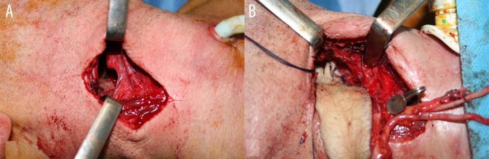 (A) Photograph of the surgical defect before reconstruction; (B) Photograph of initial location of the flap inside the oropharyngeal defect.