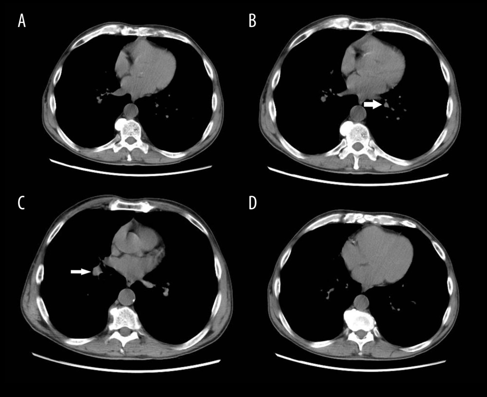 Computed tomography chest without contrast. (B) A 4-mm partially calcified nodule in left lower lobe is shown (arrow); (C) a 2.3-cm nodule in right lung base is shown (arrow); (A–D) Non-specific mediastinal lymphadenopathy is shown.