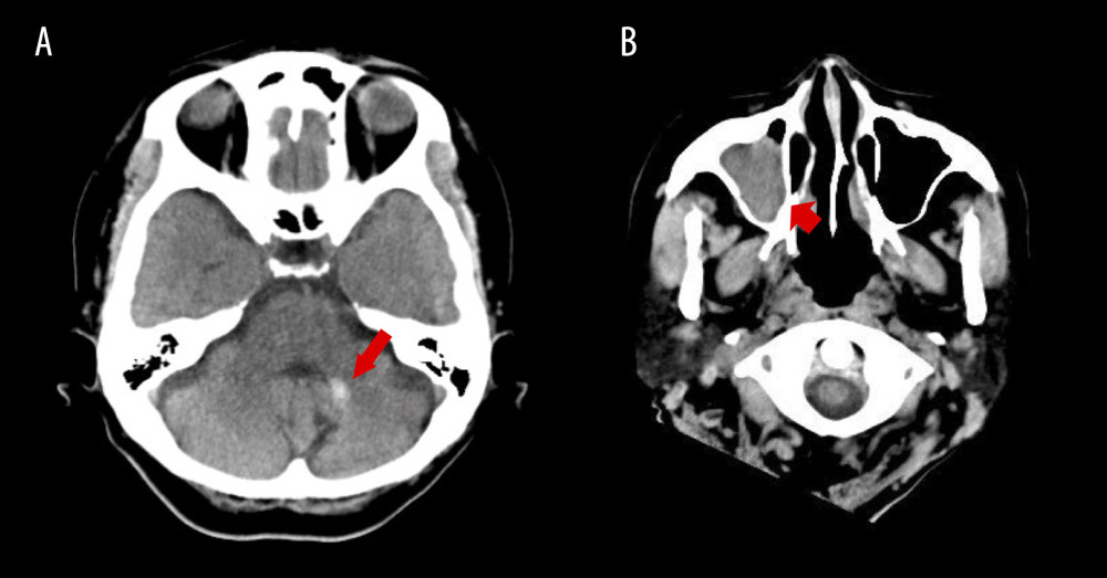 The head CT findings. (A) Head CT scan shows an intracerebral hemorrhage in the left cerebellar hemisphere (long arrow). (B) Head CT scan reveals a fluid collection in the right maxillary paranasal sinus (short arrow). CT – computed tomography