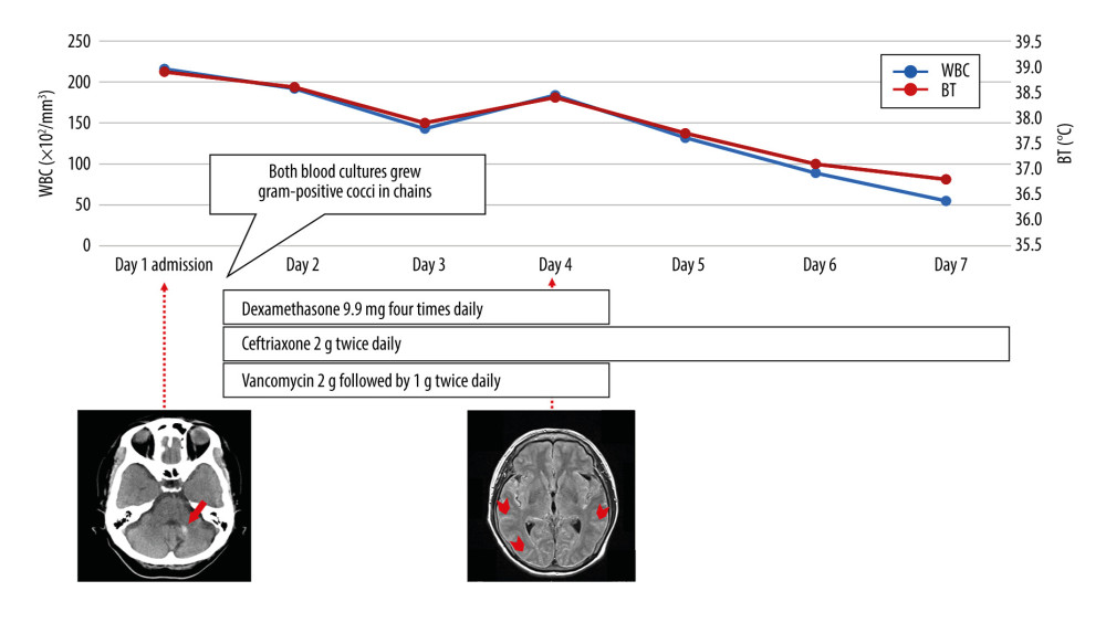 Clinical course of the patient. The head CT scan shows an intracerebral hemorrhage in the left cerebellar hemisphere (long arrow) on admission. Systemic corticosteroid and antibiotic therapies were administered 12 hours after admission. MRI fluid-attenuated inversion recovery (FLAIR) sequence performed on Day 4 shows bright sulci with features suggestive of subarachnoid hemorrhage (arrowhead). CT – computed tomography; MRI – magnetic resonance imaging