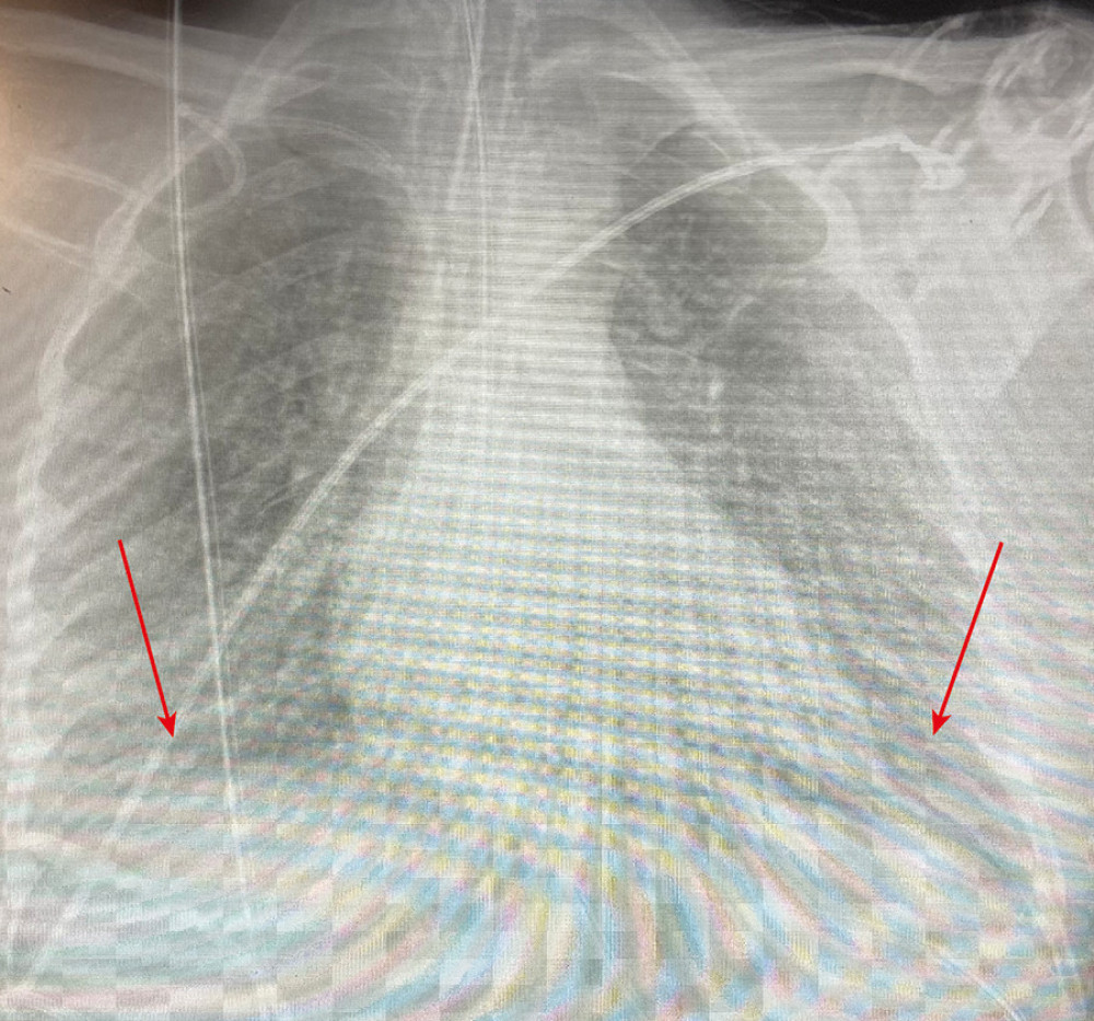 Arrow showing a bilateral pulmonary infiltration in the chest X-ray at Intensive Care Unit admission.