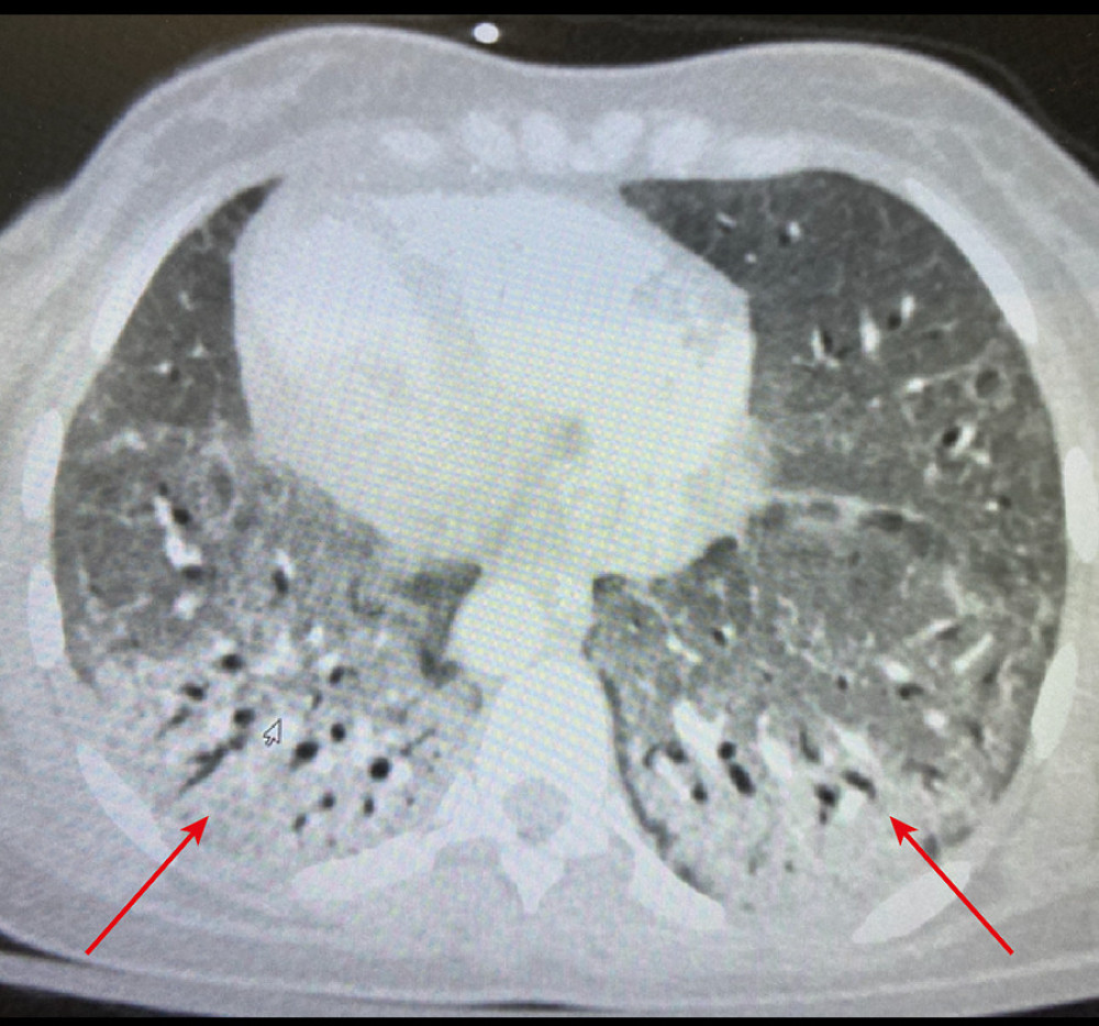 Arrow showing bilateral, peripheral, and basal predominant ground-glass opacities in the basal chest computed tomography scan.