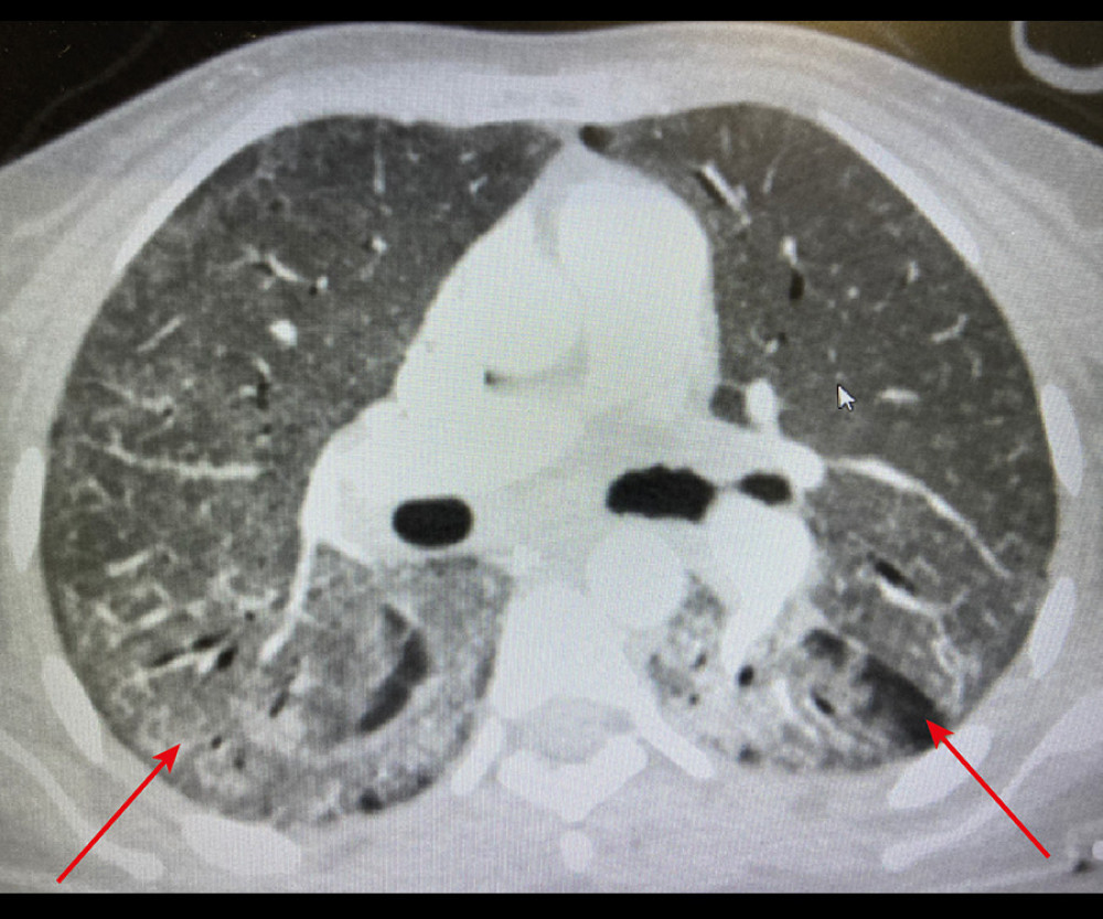 Arrow showing bilateral, peripheral, and basal predominant ground-glass opacities in the apical chest computed tomography.