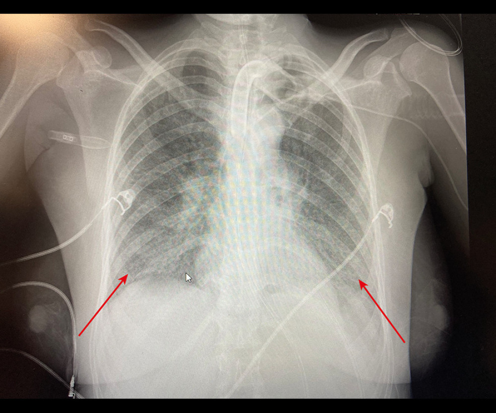 Arrow showing right ventricle moderate dilatation in the transthoracic echocardiography apical 4 chambers view.