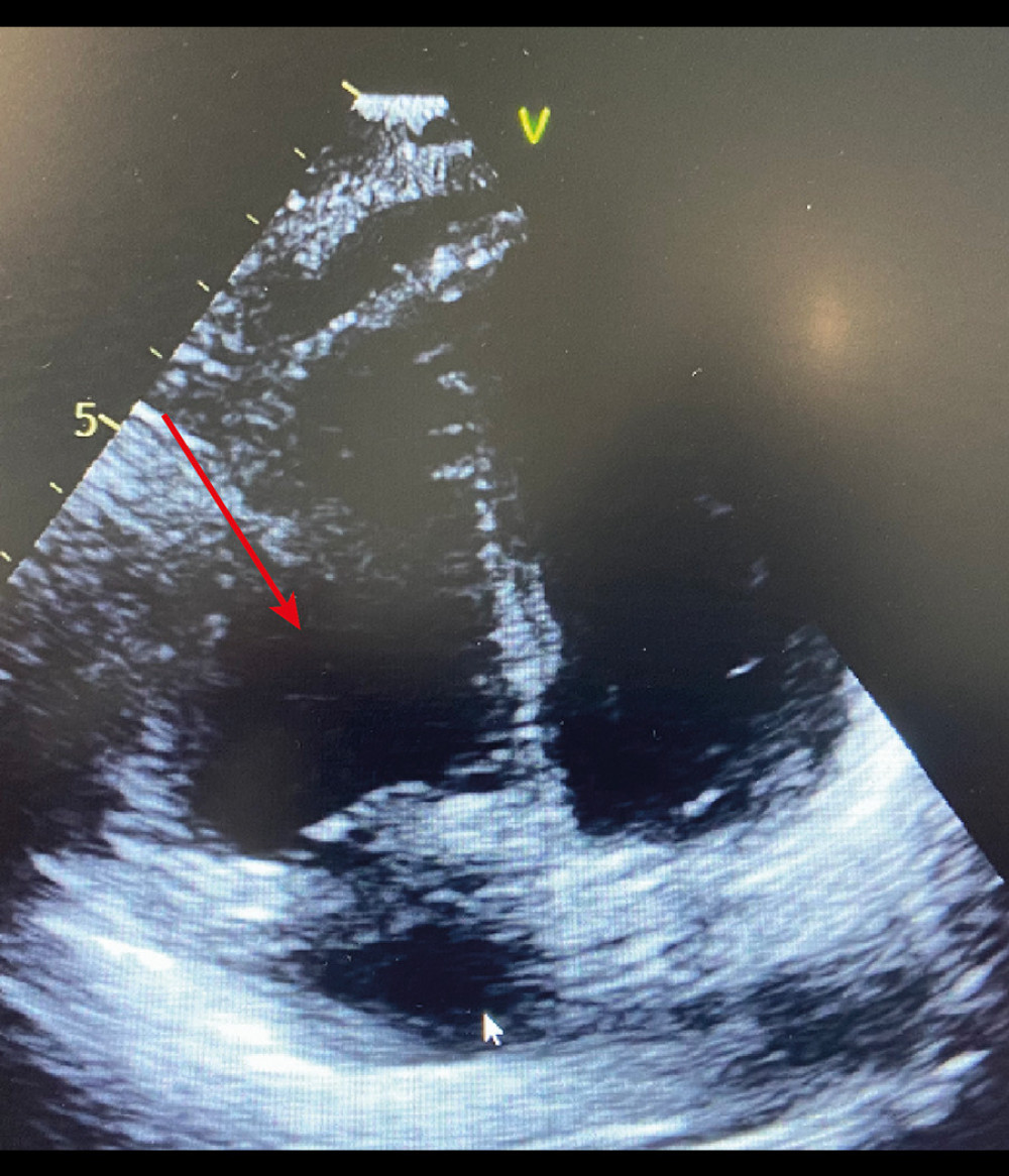 Arrow showing a D-shape of the interventricular septum at end-systole in the transthoracic echocardiography short parasternal axis view.