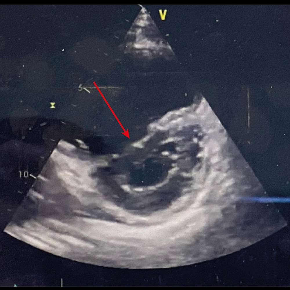 Arrow showing bilateral pulmonary infiltration, on the day of inhaled nitric oxide treatment in the chest X-Ray.