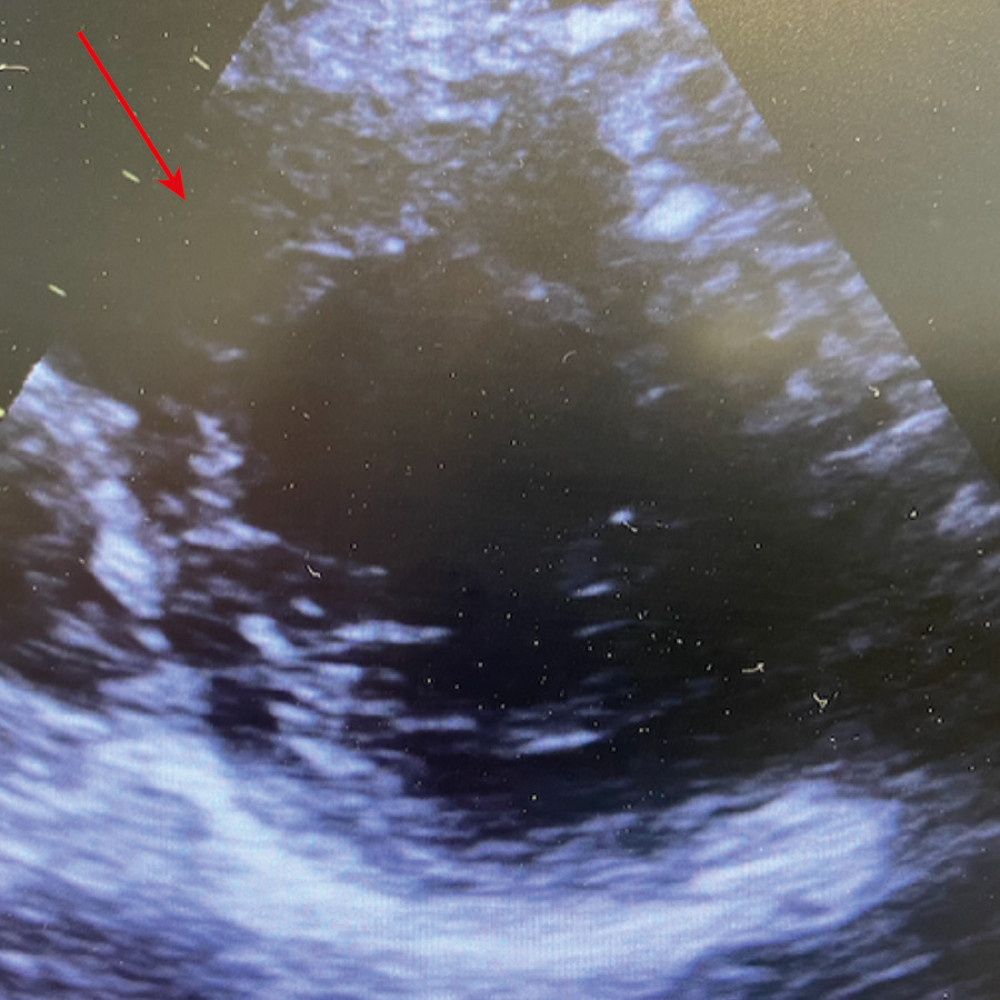 Arrow showing a normal C-shape of the interventricular septum at end-systole after inhaled nitric oxide treatment in the transthoracic echocardiography short parasternal axis view.