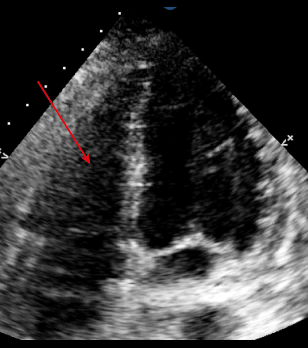 Arrow showing a non-dilated right ventricle after inhaled nitric oxide treatment. In the transthoracic echocardiography apical 4 chambers view.