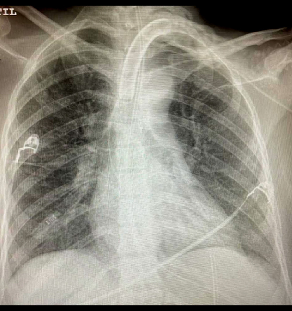 Chest X-ray showing an improvement of bilateral pulmonary infiltration after inhaled nitric oxide treatment.