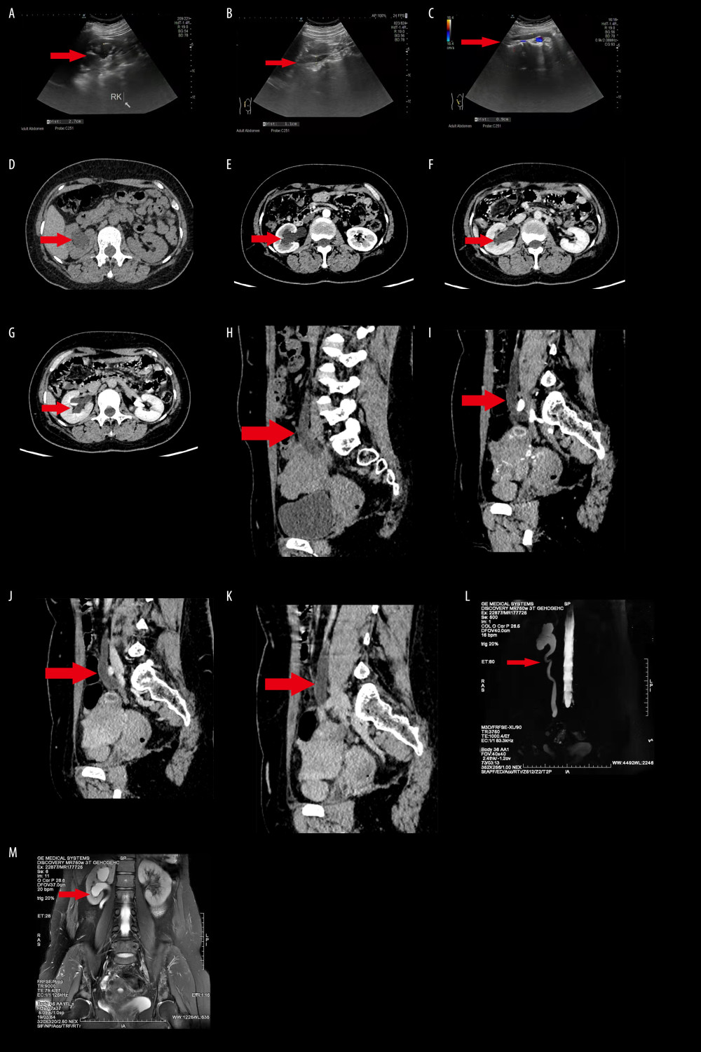 Patient imaging data. A–C): Color ultrasound of the urinary system. (A) The arrow indicates right hydronephrosis; (B, C) Arrows point to right ureteral dilatation. D–K): CT and contrast-enhanced CT. (D) CT transverse section, the arrow points to the right hydronephrosis; (E–G) Enhanced CT transverse section arterial phase, venous phase, and delayed phase, and the arrow points to the right hydronephrosis; (H) CT median sagittal (I–K) Arterial phase, venous phase, and delayed phase in the mid-sagittal enhanced CT images, arrows point to the dilation of the right lower ureter. L, M): MRI of the urinary tract. (L) The arrow points to the ureteral stenosis, and hydronephrosis and ureteral dilatation in the lower segment of the stenosis can be seen; (M) The arrow points to hydronephrosis.