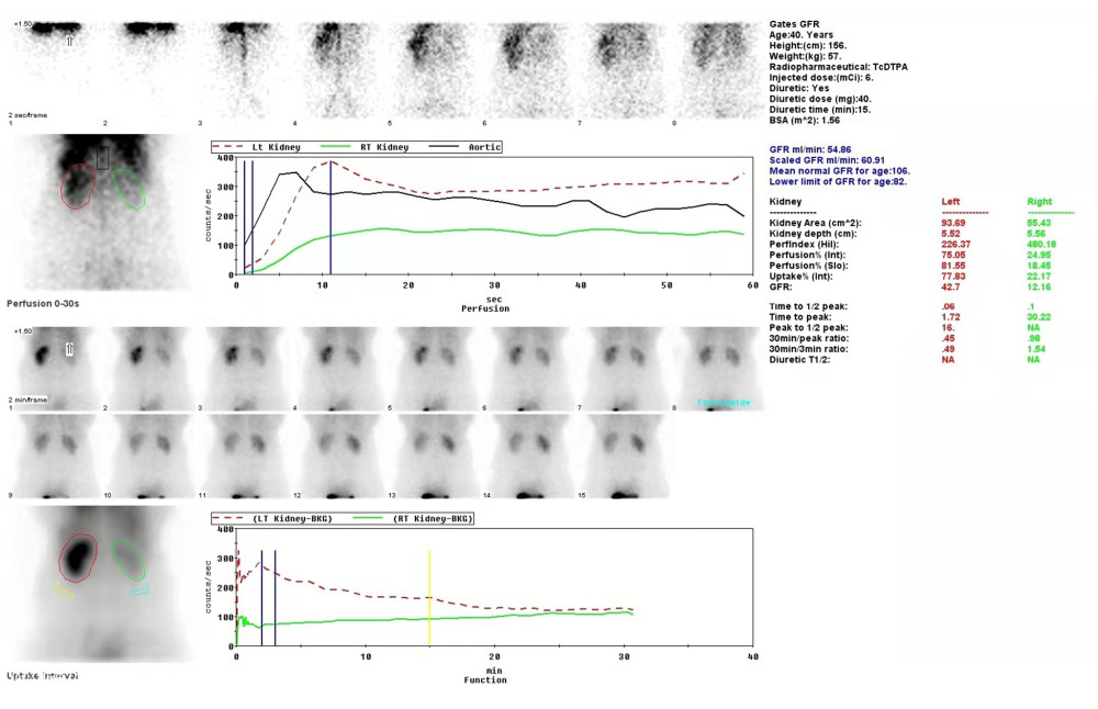 Radionuclide dynamic renal imaging examination. The figure shows that the blood perfusion of the right kidney is significantly lower than that of the left kidney, and the GFR value of the right kidney is 12.16 m/min, indicating severe renal impairment.