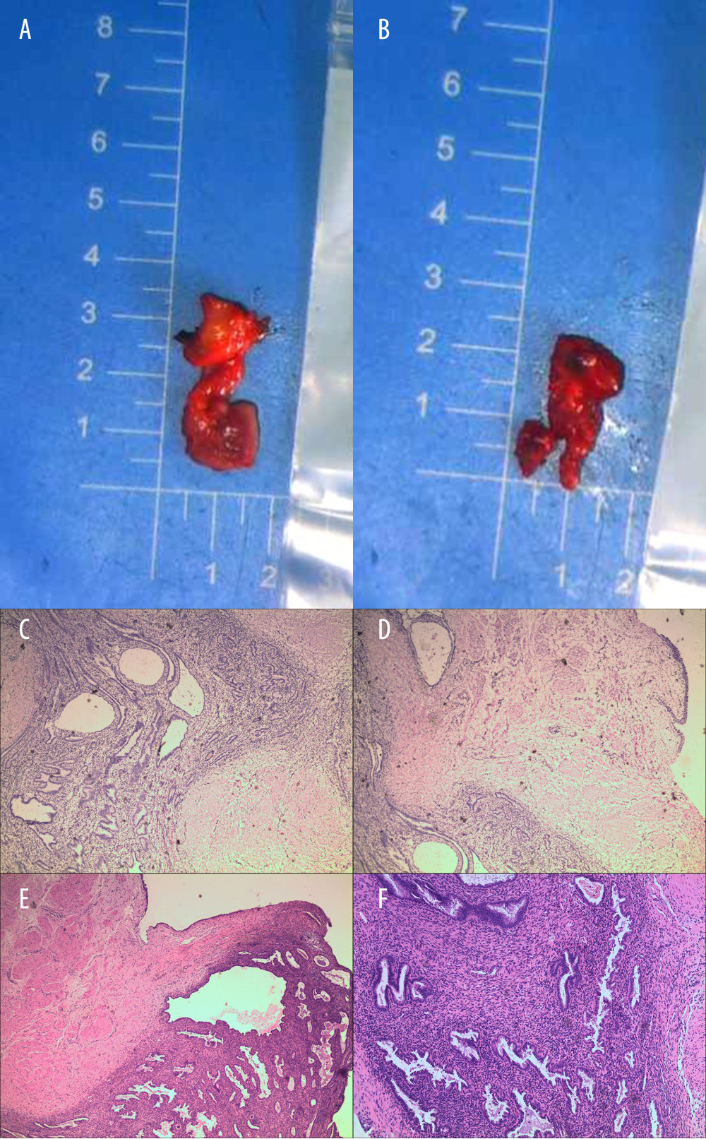 Pictures of surgically removed tissue and pathological pictures of the tissue. (A) Right mid-section stricture ureter; (B) Resection of the surrounding tissue of the ureter; (C, D) Intraoperative quick freezing pathological images, endometrial tissue can be seen in normal ureteral tissue. (E, F) 40× and 100× paraffin section images showing focal endometriosis.