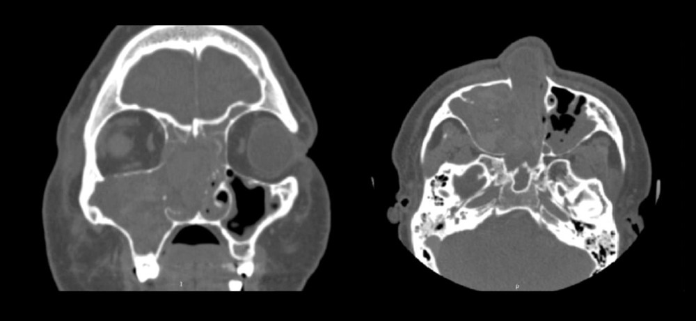 Computed tomography (CT) of maxillary sinus hemangioma. Mass of heterogeneous contrast enhancement, occupying the whole right nasal fossa with a widening of the right maxillary sinus opening and bone remodeling of the orbits and ethmoid bone on CT scans of the paranasal sinuses in coronal and axial slices.