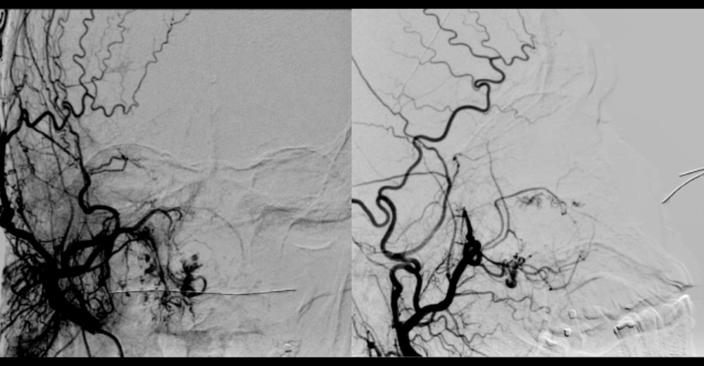 Right maxillary hemangioma arteriography. Arteriography demonstrates tumor vascularization with a predominance of the right maxillary artery of the lesion in the coronal position. After embolization of this arterial branch, the sagittal section shows an absence of contrast dissemination to the right maxillary region.