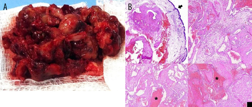 Macroscopic hemangiomatous lesion and histological evaluation. (A) Macroscopic image of a fragment of the paranasal lesion with multi-lobular aspect, friable and with several hemorrhagic spots, measuring 5×4×3 cm. (B) Histological sections reveal fragments of the respiratory mucosa (arrow) exhibiting vascular proliferation with ectatic vessels in exuberant calibers and without endothelial atypia. There are areas of thrombosis, fibrin, and organizing hemorrhage (*).