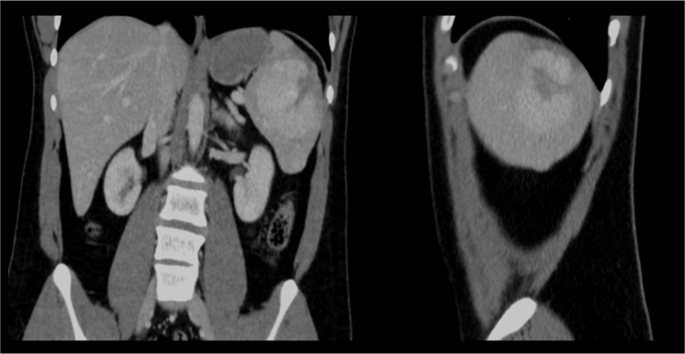 Large splenic heterogenous enhancing hypervascular lesion with central hypodensity representing a hypovascular core.