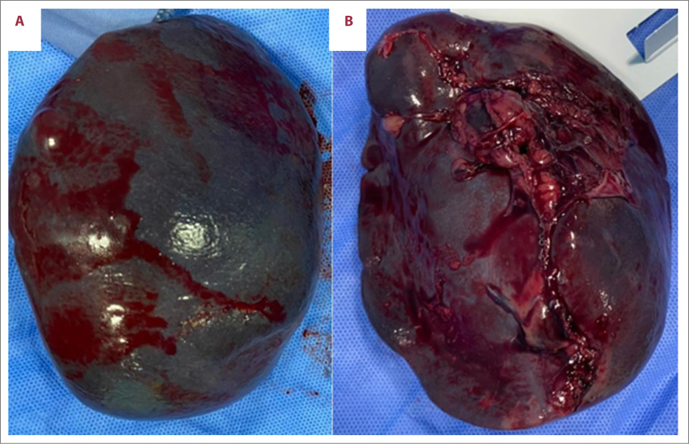 Gross spleen (A: surface; B: hilum). The resected spleen weighed 253 grams and measured 14×10×5 cm, with a smooth surface and unremarkable hilum.