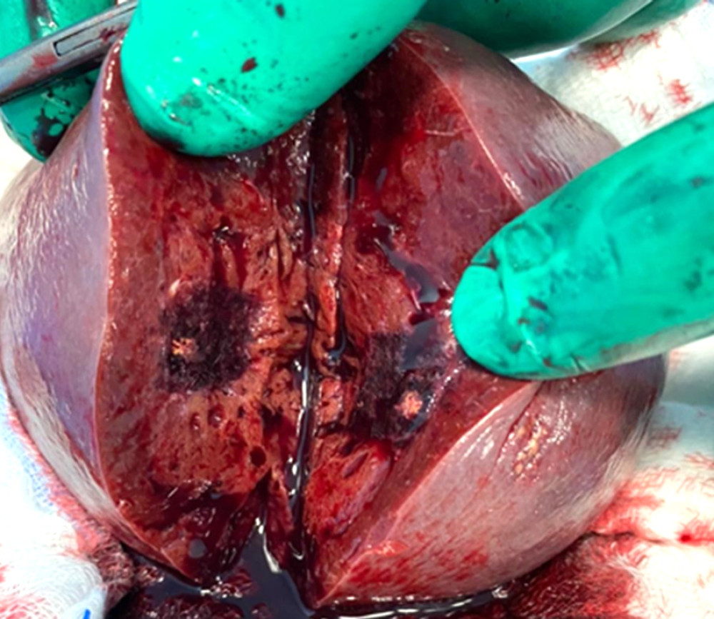 Gross spleen (cut-surface) showing a red-tan, ill-defined, bulging solid lesion with a central tan-white stellate scar.