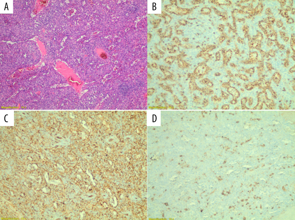 Hematoxylin-eosin staining shows a vascular lesion with absent well-formed lymphoid follicles and haphazardly arranged, small, slit-like vascular spaces of varying sizes lined by plump endothelial cells (A). The endothelial cells lining the vascular channels are positive for CD8 immunohistochemical stain (B), positive for CD31 immunohistochemical stain (C), and negative for CD34 immunohistochemical stain (D).