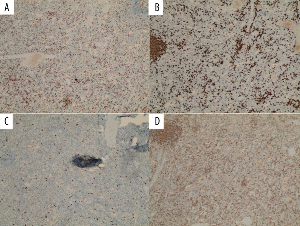 CD3-positive T lymphocytes (A) and CD20-positive B lymphocytes (B) scattered within the stroma. A low Ki-67 proliferative index is shown (C); Interspersed stromal cells immunoreactive for LCA (CD45) (D).