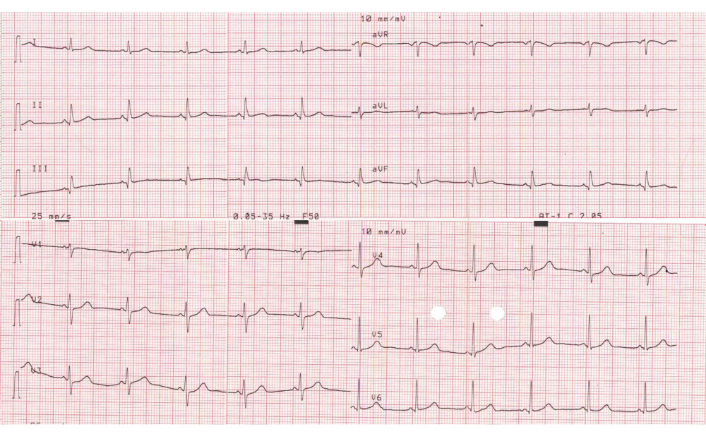 No significant abnormalities were found on the electrocardiogram image.