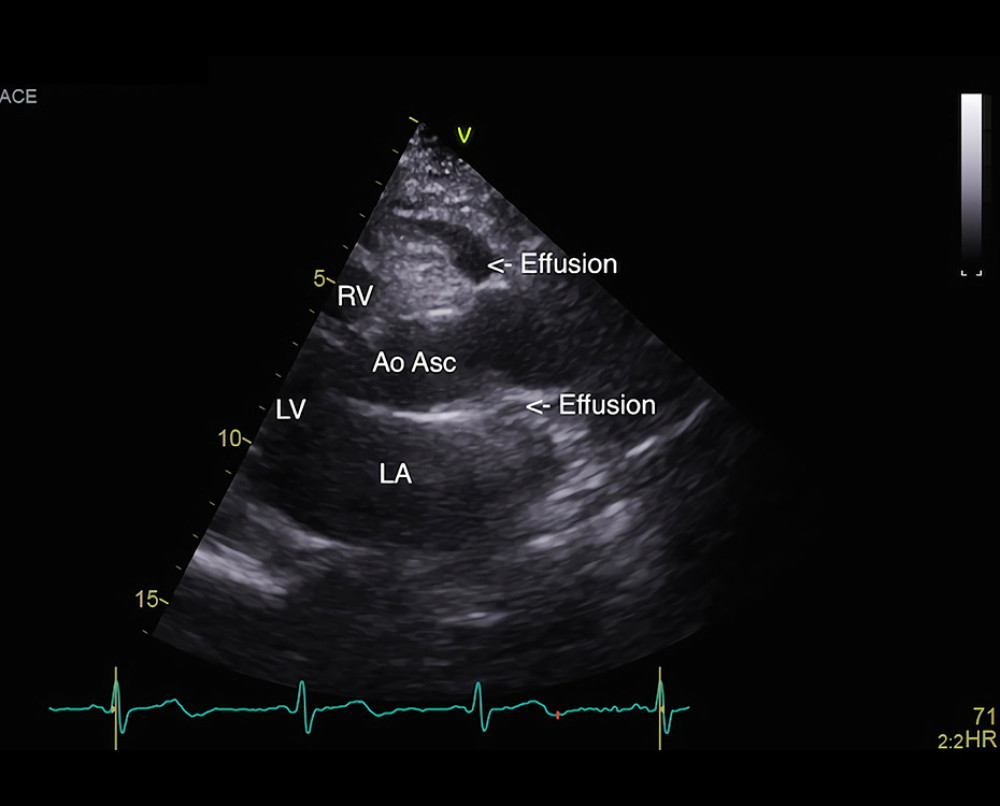 The transthoracic echocardiography in the parasternal long axis projection showed inflammatory effusion in transverse sinus, for suspicion of pericarditis. LA – left atrium; RV – right ventricle; LV – left ventricle; Ao Asc – ascending aorta