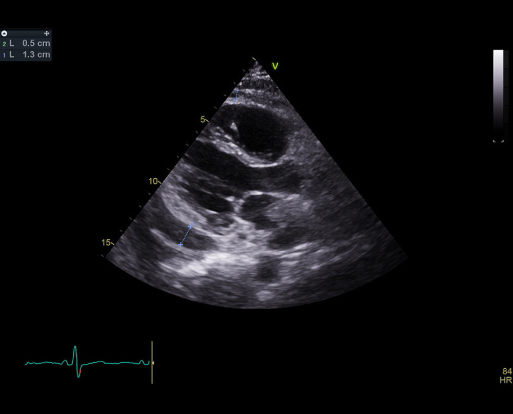 Transthoracic echocardiography showing increased amount of pericardial effusion despite immediate treatment with an NSAID (ibuprofen) and colchicine. Pleural effusion is present.