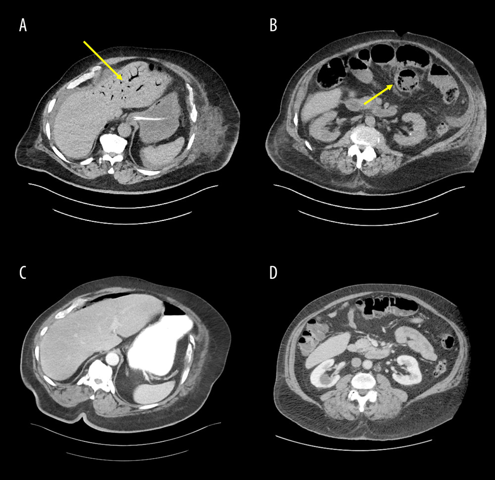 CT scans of hepatic portal venous gas and pneumatosis. A and B show the hepatic portal venous gas and the pneumatosis on the tenth day of the patient’s hospital stay (postoperative day 8) in the transverse view. The yellow arrow in A shows hepatic portal venous gas, and the yellow arrow in B shows pneumatosis. C and D show the same transverse view of the patient’s abdomen as A and B, but were taken 1 day prior to his hospitalization and show no hepatic portal venous gas or pneumatosis.