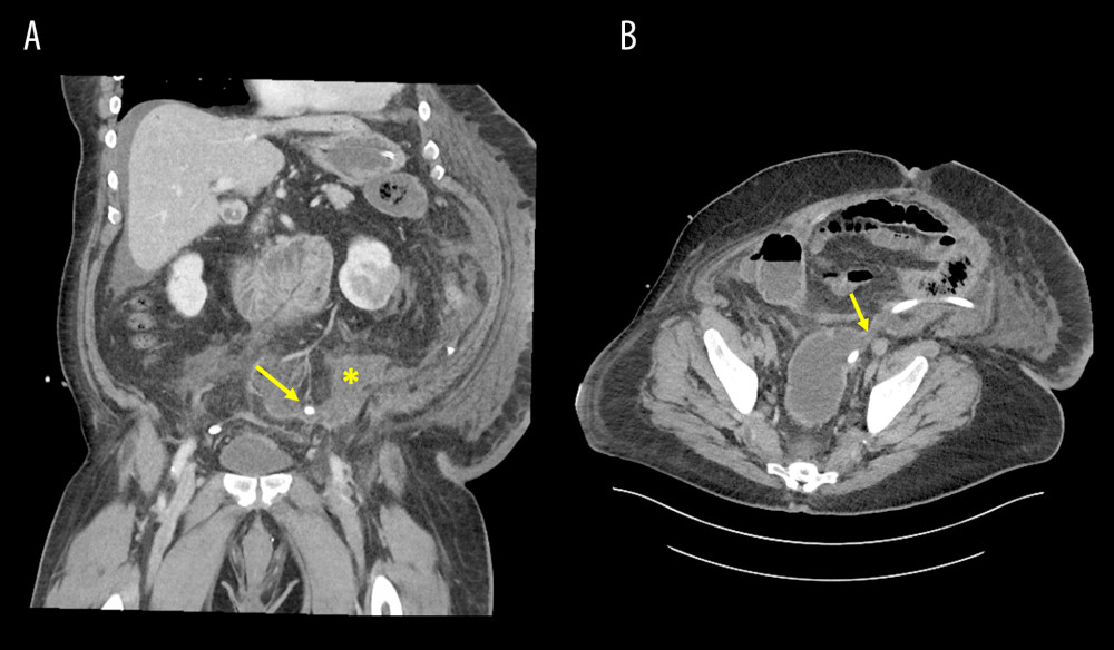 CT scans of rectal stump dehiscence with free fluid. A shows free fluid accumulation in the pelvis secondary to the rectal stump dehiscence in the coronal view. The placement of the Blake drain is indicated by the yellow arrow, and the collection of free fluid is indicated by the yellow star. B shows the rectal stump dehiscence in the transverse view. The rectal stump dehiscence is indicated by the yellow arrow.