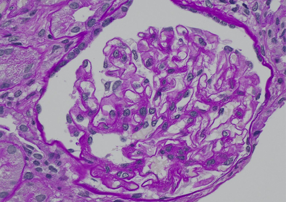 Light microscopy examination of the kidney biopsy. There was no increase in the mesangial matrix and cellularity; and no endocapillary proliferation, glomerulitis, thrombosis, necrosis, or crescents were observed (periodic acid-Schiff stain, magnification: 200×).