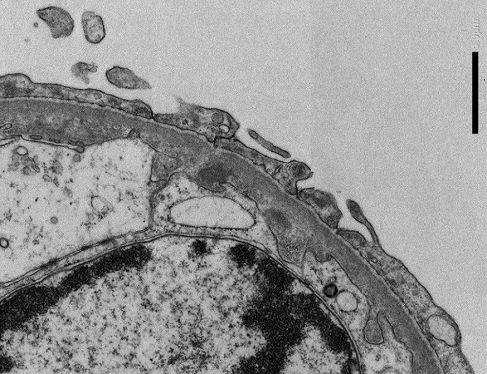 Electron microscopy showed diffuse podocyte foot-process effacement over >80% of the capillary loop surfaces, with only a few subendothelial deposits (magnification: 20 000×).