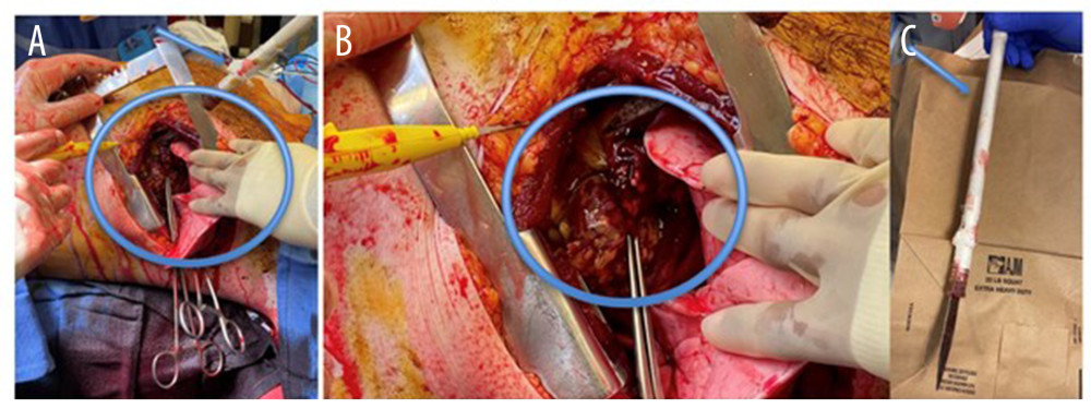 (A, B) Penetrating self-inflicted, stab wound to the chest with cardiac laceration (circle), (A, C) improvised “shank” (arrow).