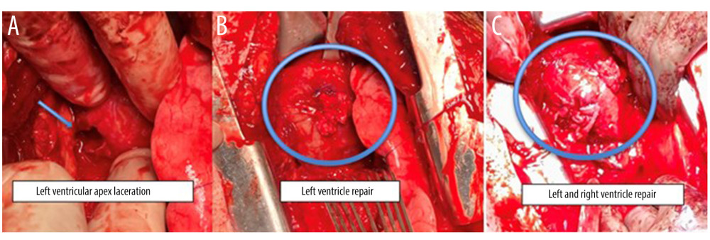 (A) Left ventricular apex laceration (arrow), (B, C) operative repair of left and right ventricle lacerations (circle).